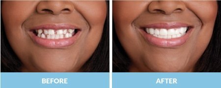 snap-on-smile4.jpg